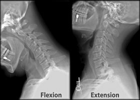 Whiplash Car accident Neck pain physiotherapy