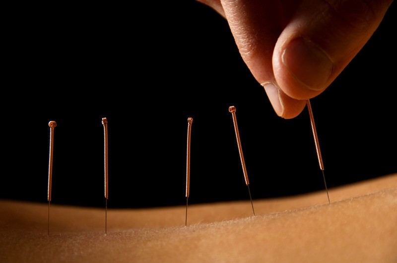 Dry needling trigger point therapy myotherapy physiotherapy