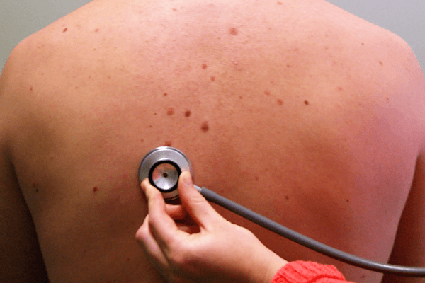 Chest Physiotherapy