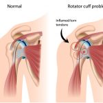 Shoulder Impingement – What is it?