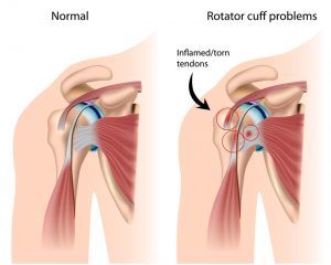 shoulder impingement rotator cuff narre warren physiotherapy